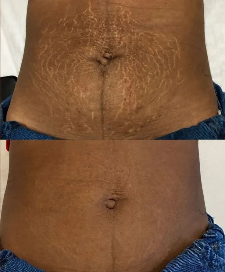 Antes e depois de estrias no abdômen