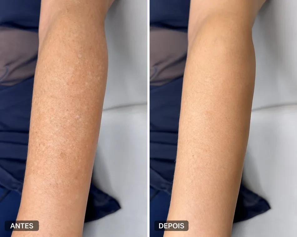 Antes e depois de manchas no braço